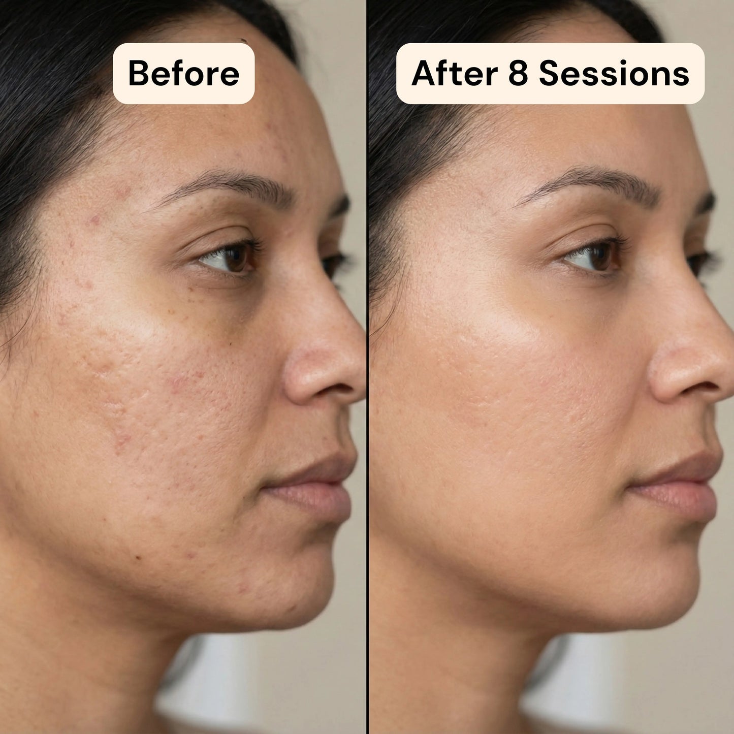 Vensory Micro-Infusion Kit™