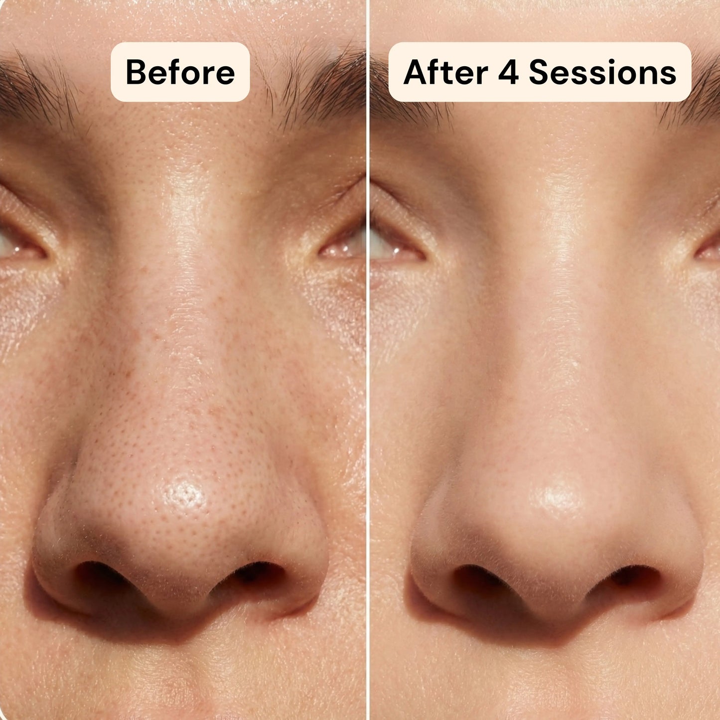 Vensory Micro-Infusion Kit™