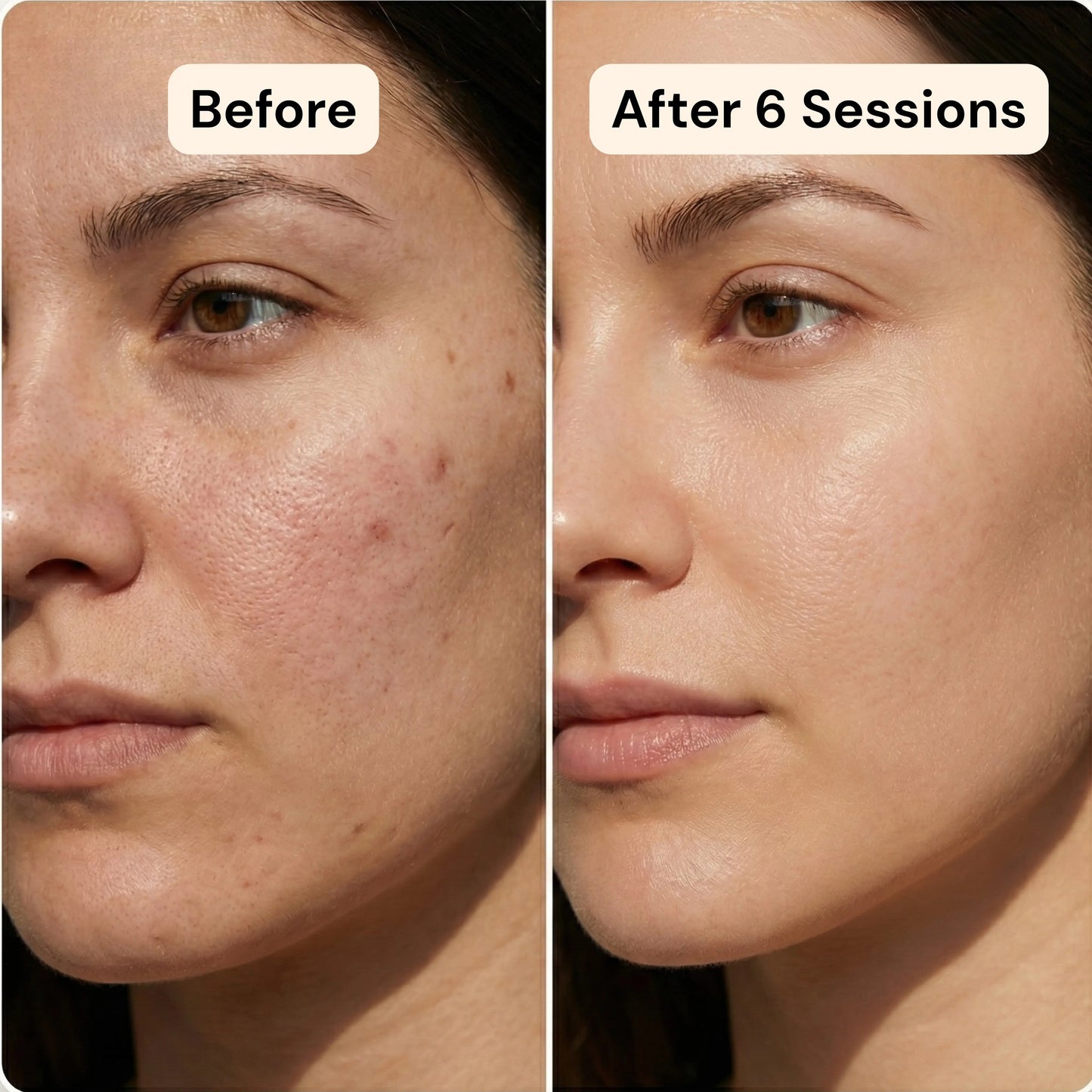 Vensory Micro-Infusion Kit™